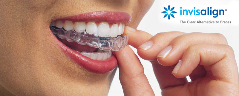 Invisalign in Gilroy, CA